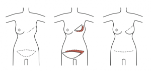 reconstrução da mama 2